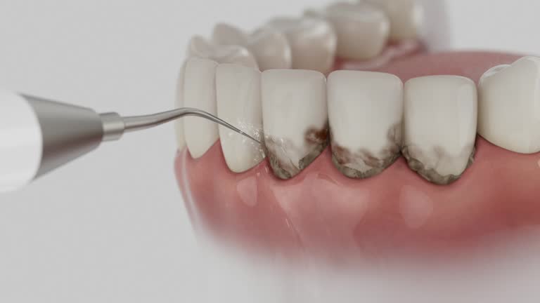 Trusted Wisdom Tooth Removal service in Oil City, PA - Dentist Open Now